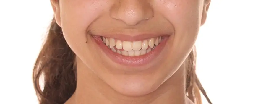 Before Facial Smiling Photo
