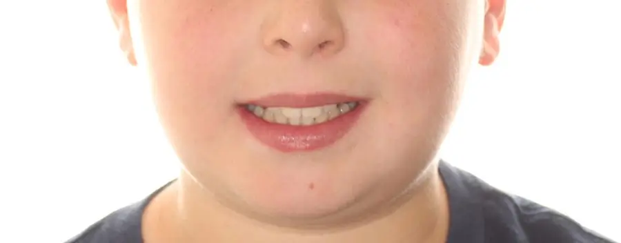 Before Facial Smiling Photo