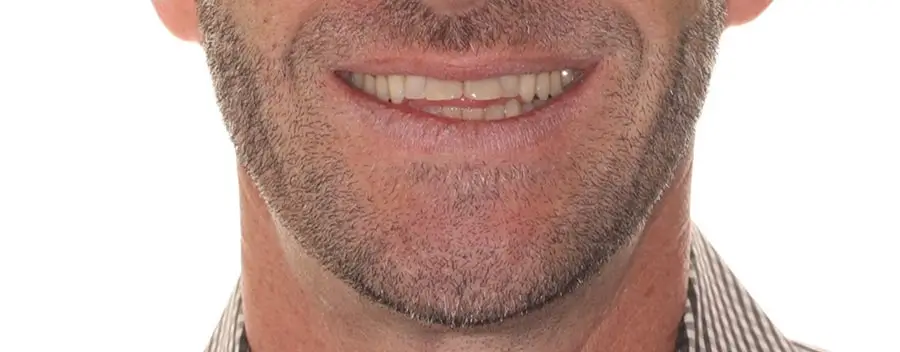 Before Facial Smiling Photo