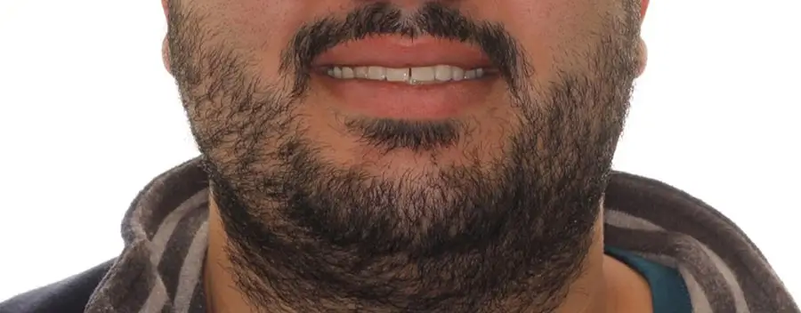Before Facial Smiling Photo