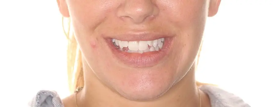 Before Facial Smiling Photo