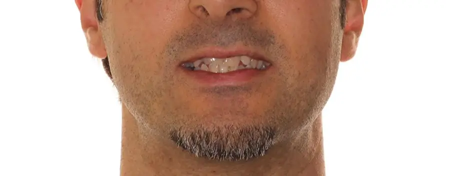 Before Facial Smiling Photo
