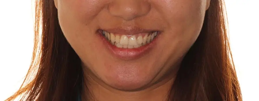 Before Facial Smiling Photo
