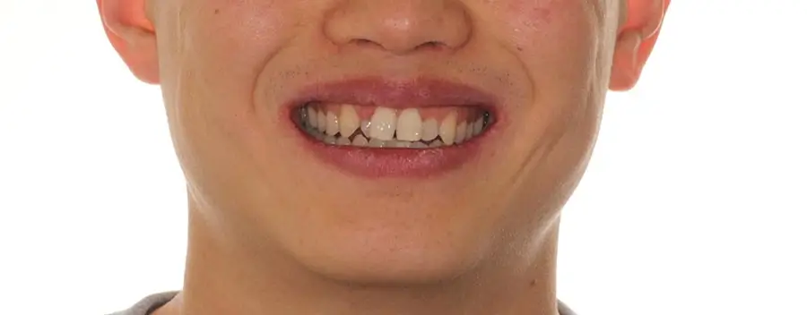 Before Facial Smiling Photo