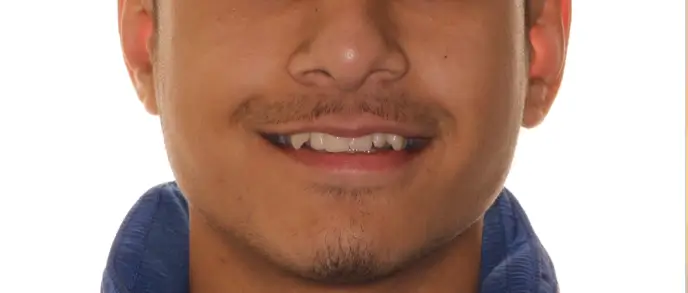 Before Facial Smiling Photo