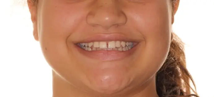 Before Facial Smiling Photo