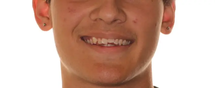 Before Facial Smiling Photo