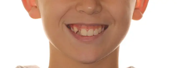 Before Facial Smiling Photo