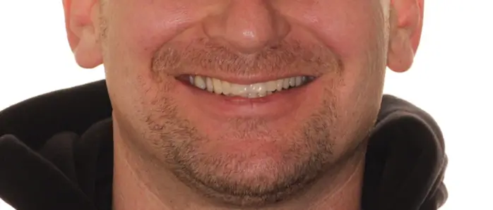Before Facial Smiling Photo
