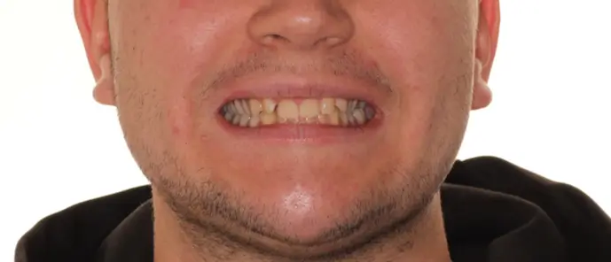 Before Facial Smiling Photo