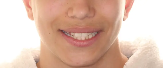 Before Facial Smiling Photo