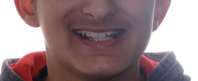 Before Facial Smiling Photo