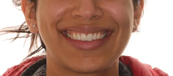 Before Facial Smiling Photo