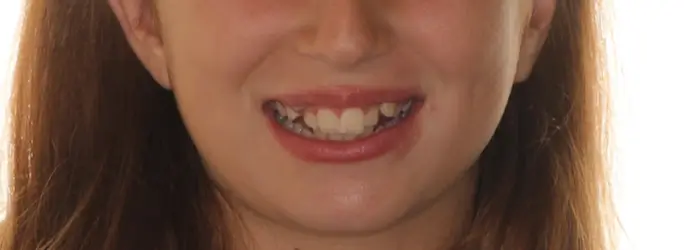 Before Facial Smiling Photo