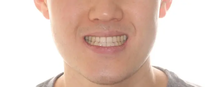 Before Facial Smiling Photo