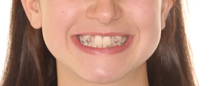 Before Facial Smiling Photo