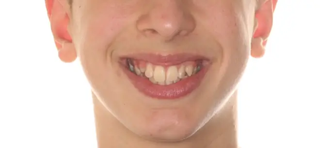 Before Facial Smiling Photo