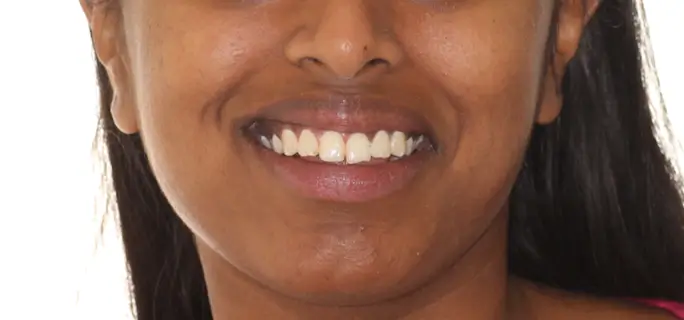 Before Facial Smiling Photo
