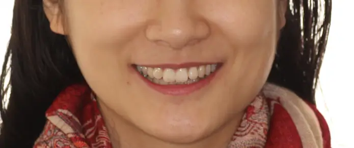 Before Facial Smiling Photo