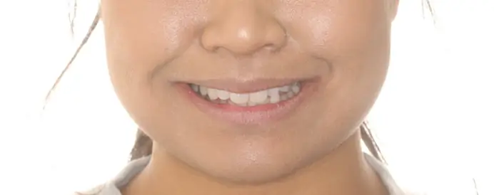 Before Facial Smiling Photo
