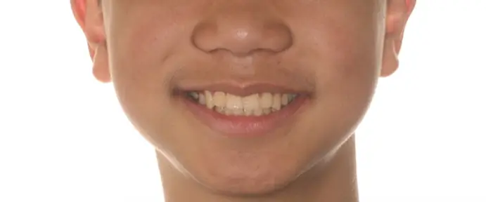 Before Facial Smiling Photo
