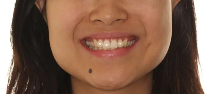 Before Facial Smiling Photo