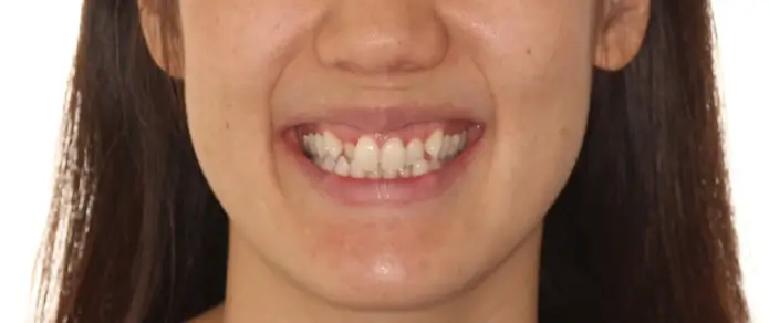 Before Facial Smiling Photo