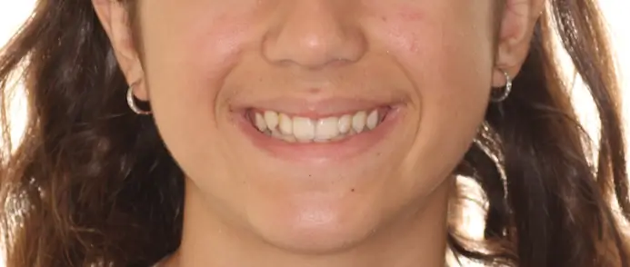 Before Facial Smiling Photo