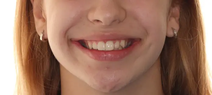 Before Facial Smiling Photo