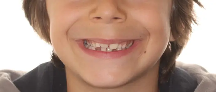 Before Facial Smiling Photo