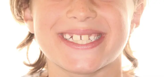 Before Facial Smiling Photo
