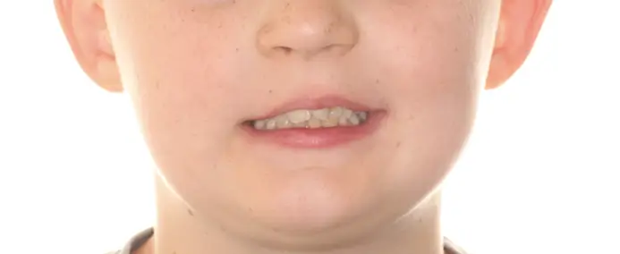Before Facial Smiling Photo