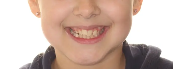 Before Facial Smiling Photo