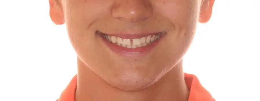 Before Facial Smiling Photo