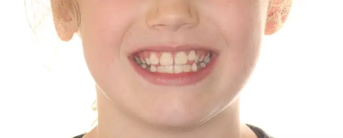 Before Facial Smiling Photo
