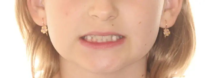 Before Facial Smiling Photo