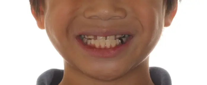 Before Facial Smiling Photo