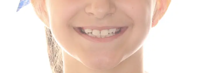Before Facial Smiling Photo