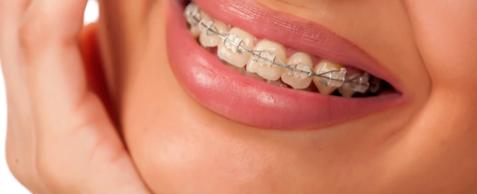 Do-clear-or-LightForce-braces-turn-yellow-post-img