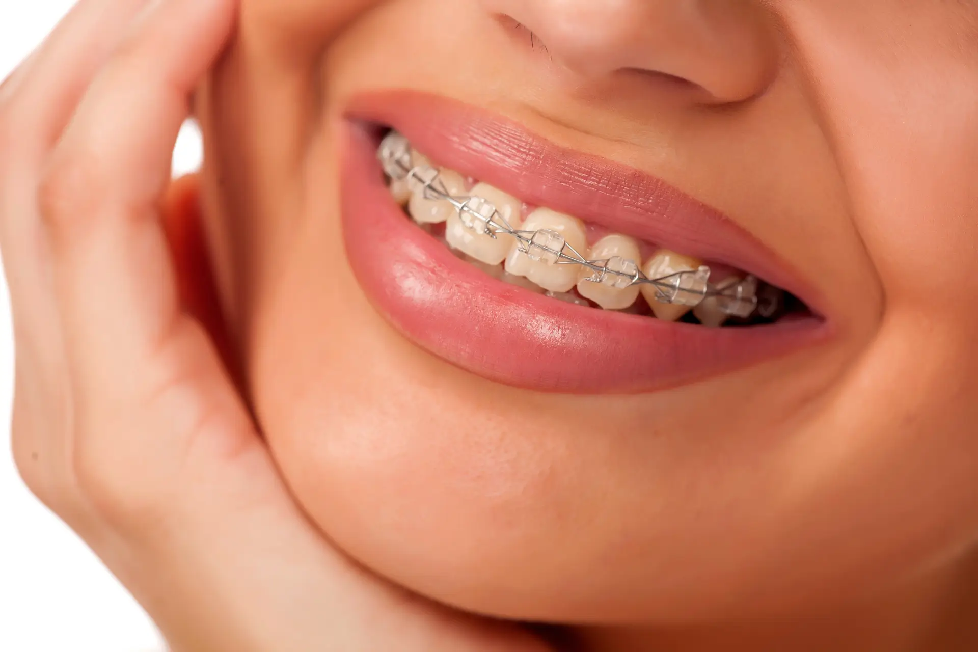 Do-clear-or-LightForce-braces-turn-yellow-post-img