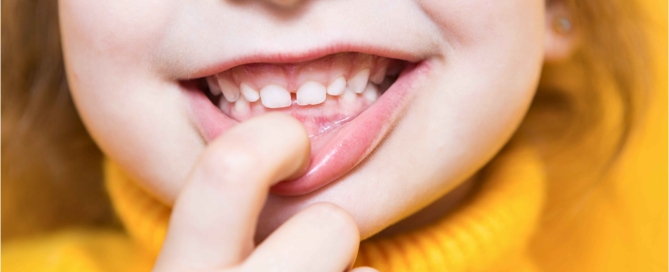 Is-It-Okay-To-Live-With-An-Overbite-Vaughan-Orthodontist