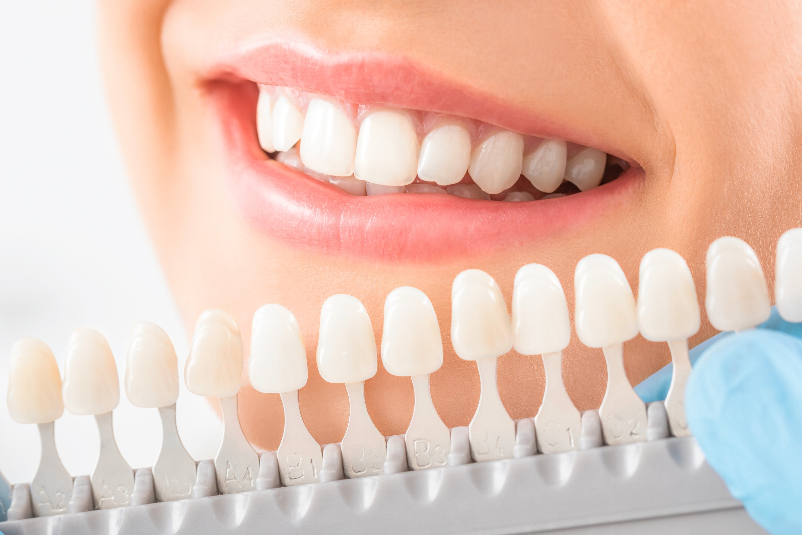 Is-Teeth-Whitening Painful-Vaughan-Orthodontist