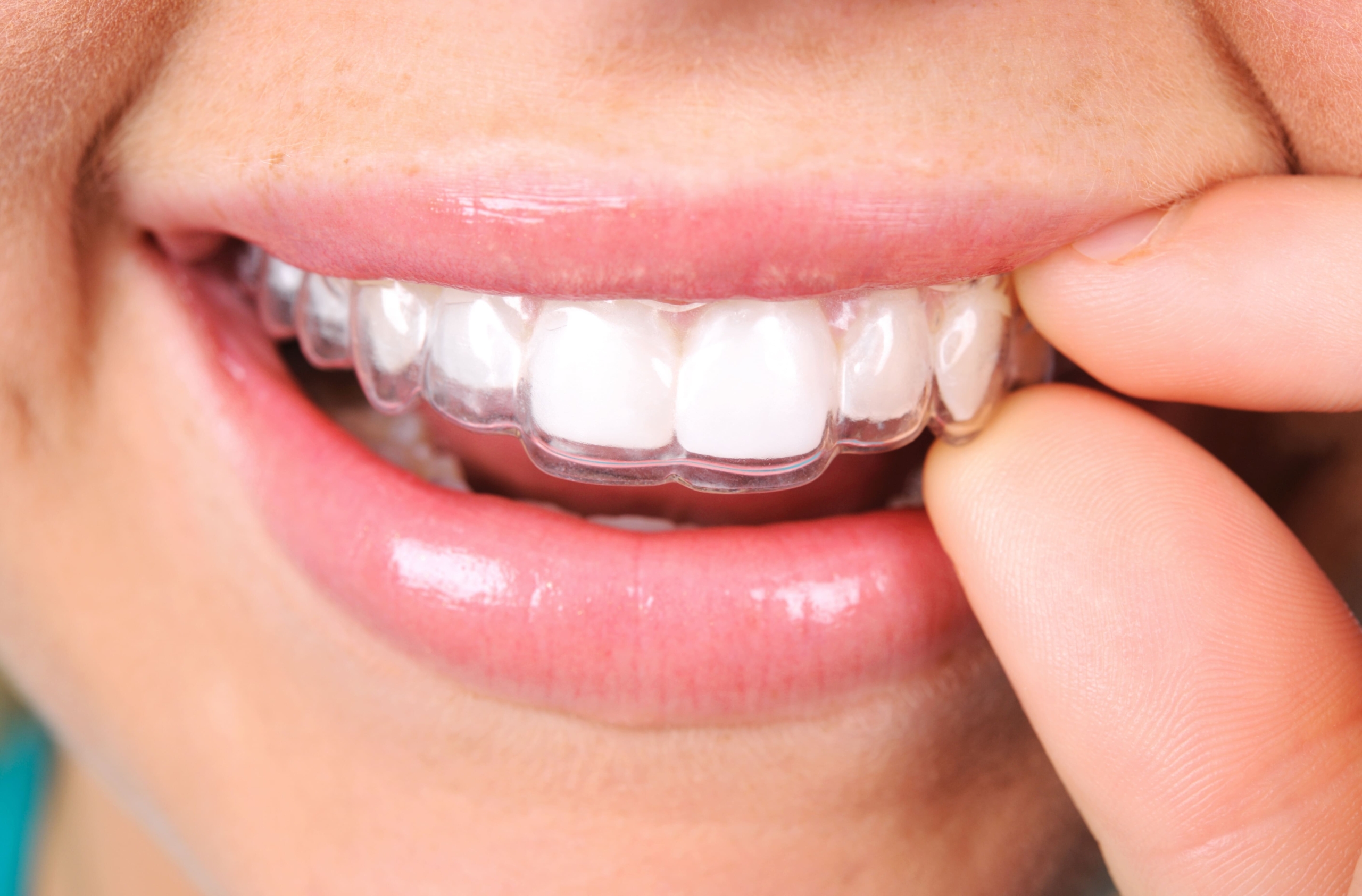 How_Quickly_Will_Teeth_Shift_Without_A_Retainer_Vaughan-Orthodontist-Dr-Walt